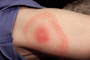 萊姆病症：一種經由壁蝨（蜱蟲）咬傷感染，卻被醫師誤會心理問題的狡猾疾病 Special Erythema migrans erythematous rash in Lyme disease