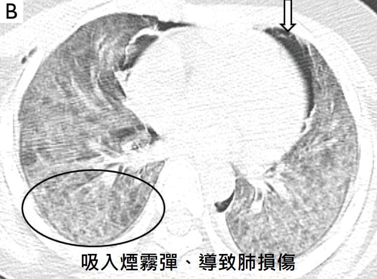 臺北捷運恐攻:揭開煙霧彈背後的「延遲性肺損傷」威脅 2 img 5656